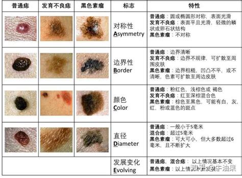 臉突然長痣|痣是什麼？會變成黑色素瘤？7種一定要除的痣